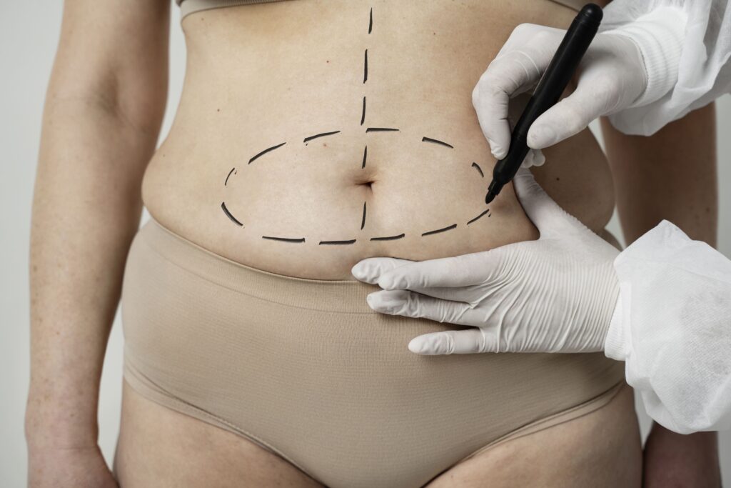 Cirurgia Reparadora Pós Bariátrica. Foto de cirurgia abdomen.